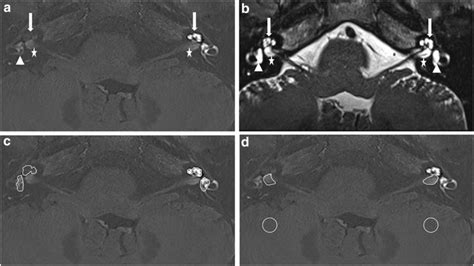 the villages mri side effects|Gadopentetate (Intravenous Route) Side Effects .
